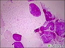 Thus, diets low in fats and cholesterols do not affect the neurological disease course. Niemann Pick Disease Healthing Ca