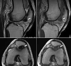 This section of the website will explain large and minute details of sagittal knee use the mouse scroll wheel to move the images up and down alternatively use the tiny arrows (>>) on both side of the image to move the images. The Mri Revealed A Solitary Mass In The Knee Joint Cavity Or Download Scientific Diagram