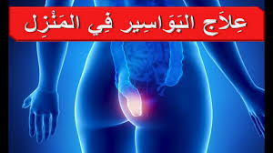مرض البواسير الشرجية الداخلية والخارجية علاج وطرق خلطات وصفات سهلة فعالة دون عمليات جراحة البواسير Youtube