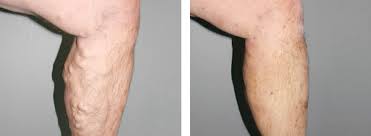 Operaciya Po Udaleniyu Varikoznyh Ven Na Nogah Hirurgicheskoe Udalenie Ven Pri Varikoze Ceny V Moskve Hirurgiya Ven