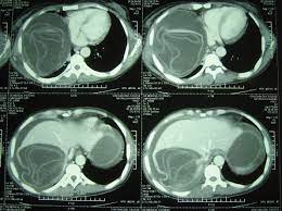 Check spelling or type a new query. Hydatid Cysts Of The Liver Diagnosis Complications And Treatment Intechopen