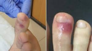 Tarikan dinding dada, takipnea :<2 bulan, ≥60x/menit; Semakin Beragam Inilah 10 Gejala Virus Corona Yang Paling Penting Untuk Dikenali Semua Halaman Kids