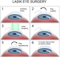Does my insurance pay for lasik eye surgery? unfortunately, most major health insurance providers such as blue cross blue shield don't cover lasik surgery under their standard plans as lasik is considered an elective procedure. Lasik Eye Surgery Top Eye Specialist Best Rated Nyc Ophthalmologist