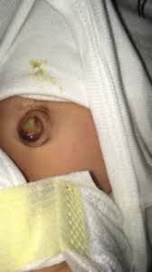 Ayuda Sera Q Esta Infectado El Ombligo Club De Bebes Mayo 2018 Babycenter