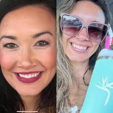 Short story long 😆 Nearly nine months Botox freeeeee 💉 I have been doing  it for nearly 6-7 years every 3 months. Last year 2024 I did Jan, March,  June, & December.