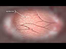 Rosveda skin medical 2 για ουλεσ ραγαδεσ. Etsi Dhmioyrgoyntai Ragades Sthn Epidermida Ti Na 3erete Iatropedia