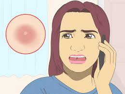 11 Ways to Get Rid of a Mosquito Bite