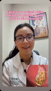 ⚠️¿Sabías que 3 de cada 10 pacientes pueden presentar cálculos en la  vesícula biliar luego de perder peso de forma rápida?, ✅Claro, esto no es  una razón para no seguir en plan de pérdida de peso que ...