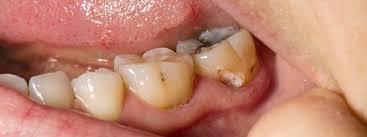 Wisdom tooth pain, how to manage from home until you can see a dentist. How Do You Get Rid Of Wisdom Teeth Pain At Home