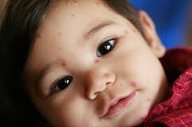 Image result for shingles in children