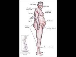 Short And Long Term Side Effects From Corticosteroids Medical Terms Steroids Side Effects Side Effects