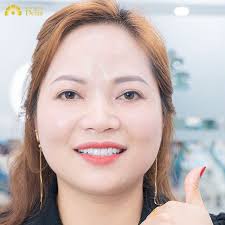 Sở hữu nụ cười trọn vẹn sau 1 năm làm răng sứ