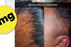 Many people also take the supplement to increase their hair growth rate, and the results vary from one person to the other depending on several metabolic factors. This Biotin Shampoo S Before And After Photos Will Have You Believing In Miracles