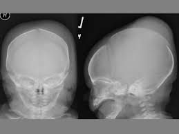 Image result for Skull XRay