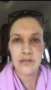 Please what cream or soap can I use to treat eyzema