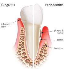 Surbiton Smile Dentist Kingston Surrey Root Canal Treatment To Reduce Cardio Vascular Diseases