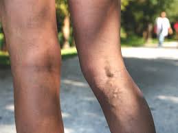 .prevalence of varicose veins and chronic venous insufficiency in men and women in the general 100. Varicose Vein Pain What It Feels Like And Relief