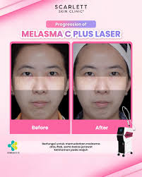 Scarlett Skin Clinic+ Depok (@scarlettskinclinic.depok) • Instagram photos  and videos