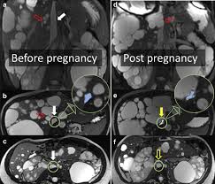 Irina barash is a member of vimeo, the home for high quality videos and the people who love them. Prevalence Of Inferior Vena Cava Compression In Adpkd Kidney International Reports