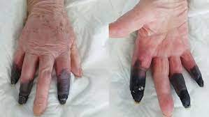 Eine rasche diagnose und behandlung sind wichtig. Nach Corona Infektion 3 Finger Dieser Frau Sterben Ab Amputation