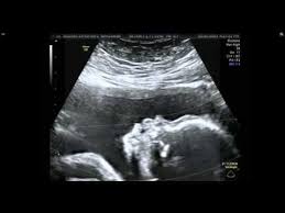 4d Ultrasound Obstetric Ultrasound Unilateral Pleural Effusion Hydrothorax In 4d Scan Obstetric Ultrasound Pleural Effusion 4d Ultrasound