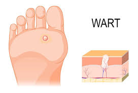 A variety of warts affect the feet. How To Use Apple Cider Vinegar To Remove Plantar Warts