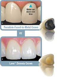 Delhi Dental Center Dental Crown Dental Crown India Tooth Crown India Porcelain Crown India Dental Crown Clinic India Dental Crown Dentist India Dental Crown Bridge Dentist At Delhi Dental Center For Zirconia Metal Free All Ceramic Full