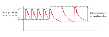 Image result for Pulse Pressure