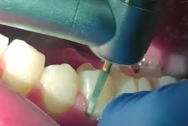 However, it's possible that some glue could get left behind. How Are Braces Removed Premier Orthodontics