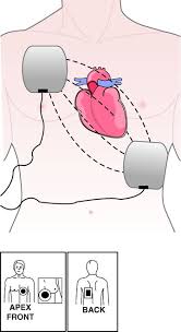 Paddle position on the human v entricular m y ocardium. Cardiopulmonary And Cerebral Resuscitation Chapter 3 An Introduction To Clinical Emergency Medicine