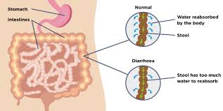 I love it when that happens. Diarrhoea Causes Symptoms Treatment Support Guts Uk