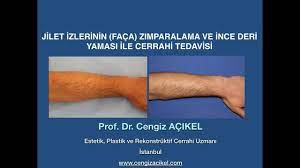 jilet faca izlerinin cerrahi tedavisi jilet izi tedavisi youtube