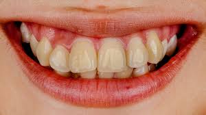 White glowing and sparkling teeth is a natural desire of every one. Causes Of Post Braces Stains On Teeth How To Remove Them