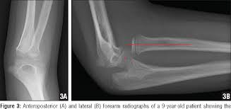 Image result for Radial Head Dislocation