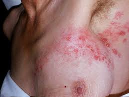 Shingles is caused by reactivation of the varicella zoster virus, the same virus that causes chickenpox.; Herpes Zoster Medibas