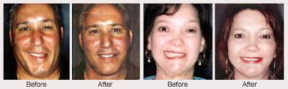 Check spelling or type a new query. Facial Paralysis And Bell S Palsy Surgery Specialist Upper East Side New York Ny Elliott H Rose Md Plastic Surgeon The Aesthetic Surgery Center