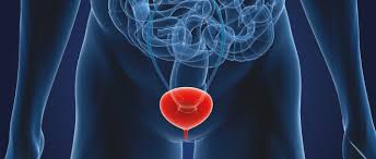 Read about bladder cancer symptoms, signs, treatment, prognosis, survival rates, staging, and causes. Bladder Cancer World Cancer Research Fund International