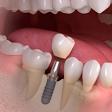 Dental Implants product image