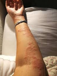 Atopisches ekzem, atopische dermatitis) ist eine sehr häufige, chronische, nicht ansteckende hautkrankheit. Neurodermitis Symptome Und Ausloser Nach Anthony William Medical Medium Eczema Free Life