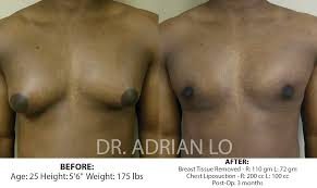 Image result for Gynecomastia
