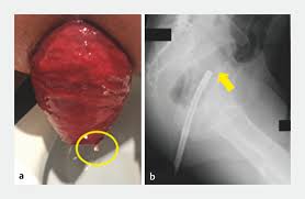 Image result for Rectal prolapse