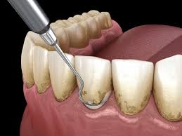 Professional gingivitis treatment and prevention. Gum Disease Periodontal Disease Treatment Nashoba Family Dentists