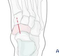 Primary fusion of naviculocuneiform joint for Complete ...
