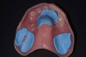 Do not use commercial fizz type cleaners as they contain oxidizing agents that will cause the liner to discolor and get hard over time. 8 Considerations In Denture Relining Spear Education
