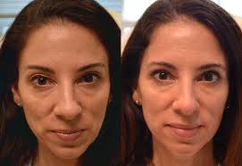 Ever wanted to impress your friends and family or win the admiration of a love interest? Upper Eyelid Blepharoplasty Surgery Book An Appointment