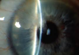 Herpes simplex virus (hsv) stromal keratitis and endotheliitis. Ophthalmology Management Special Section Sponsored By Bausch Lomb