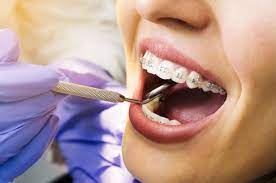 All good things take time. Dental Braces Treatment Details Removal Recovery