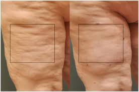 Most doctors believe cellulite is caused by poor elasticity in the skin. Best Cellulite Treatment For Men Builtlean