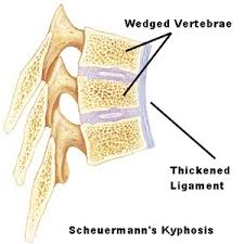 Scheuermann's kyphosis involves wedging of vertebrae (generally thoracic) which creates a kyphotic deformity >45 degrees. Scheuermann S Kyphosis Treatment Surgery Melbourne Fl Merritt Island