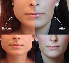 Botox for Teeth Grinding